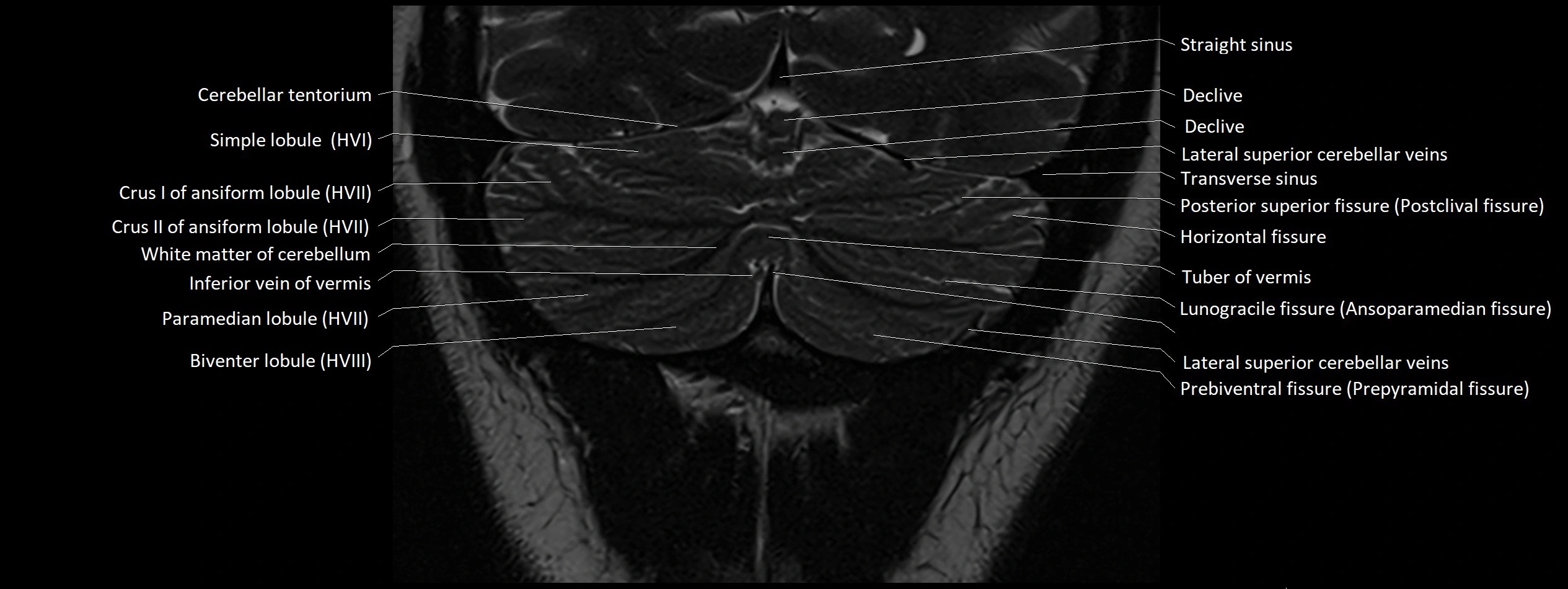 Anatomy of cerebellum coronal cross sectional 3T image 24.webp
